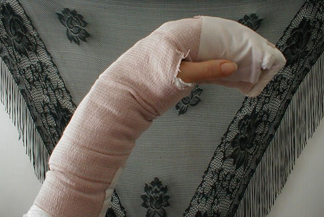 PostOp from when she cut her fret hand